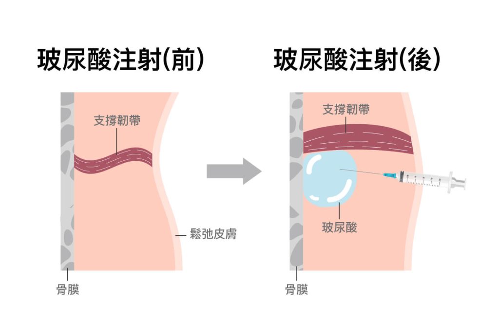 玻尿酸注射前後效果