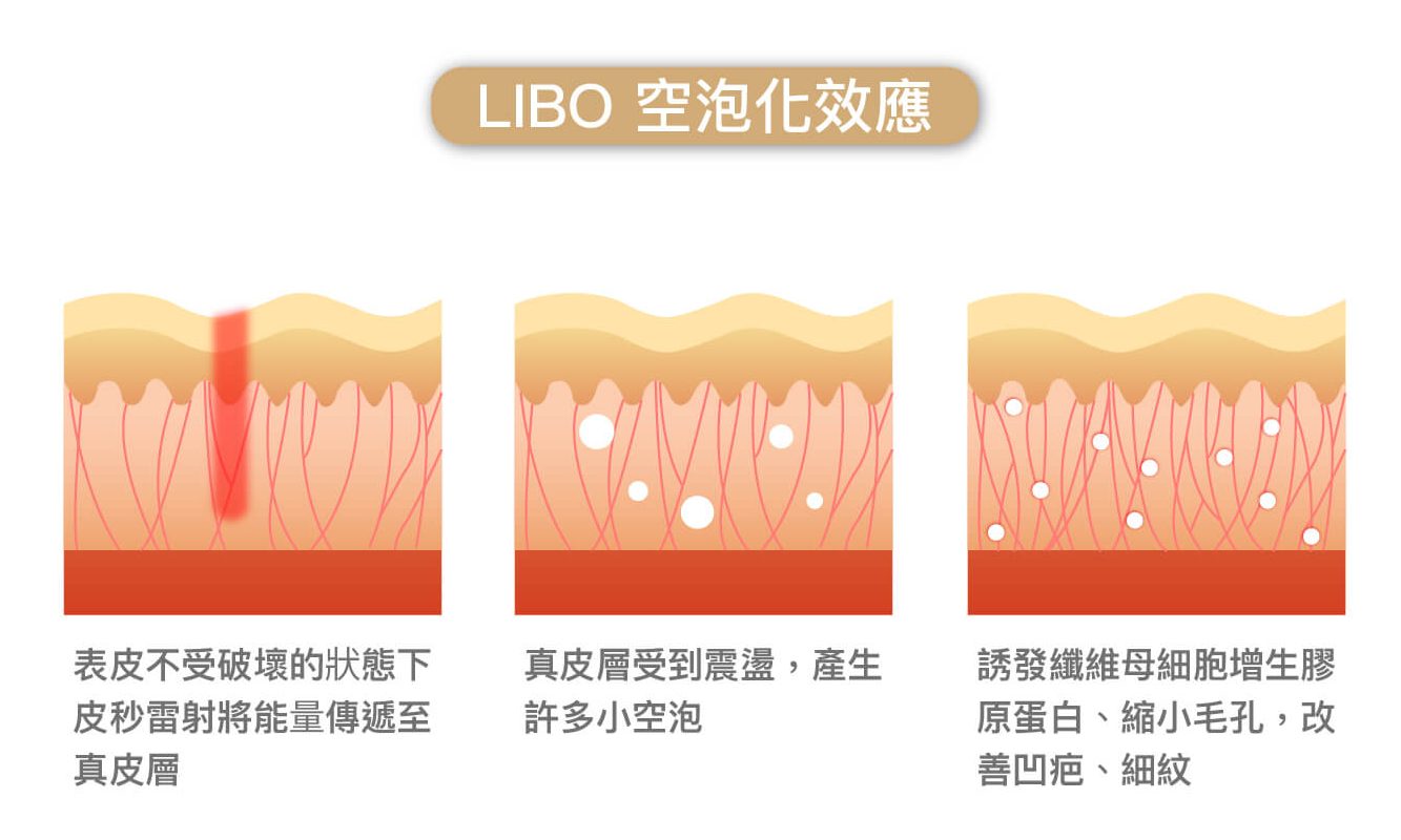 皮秒雷射空泡化效應