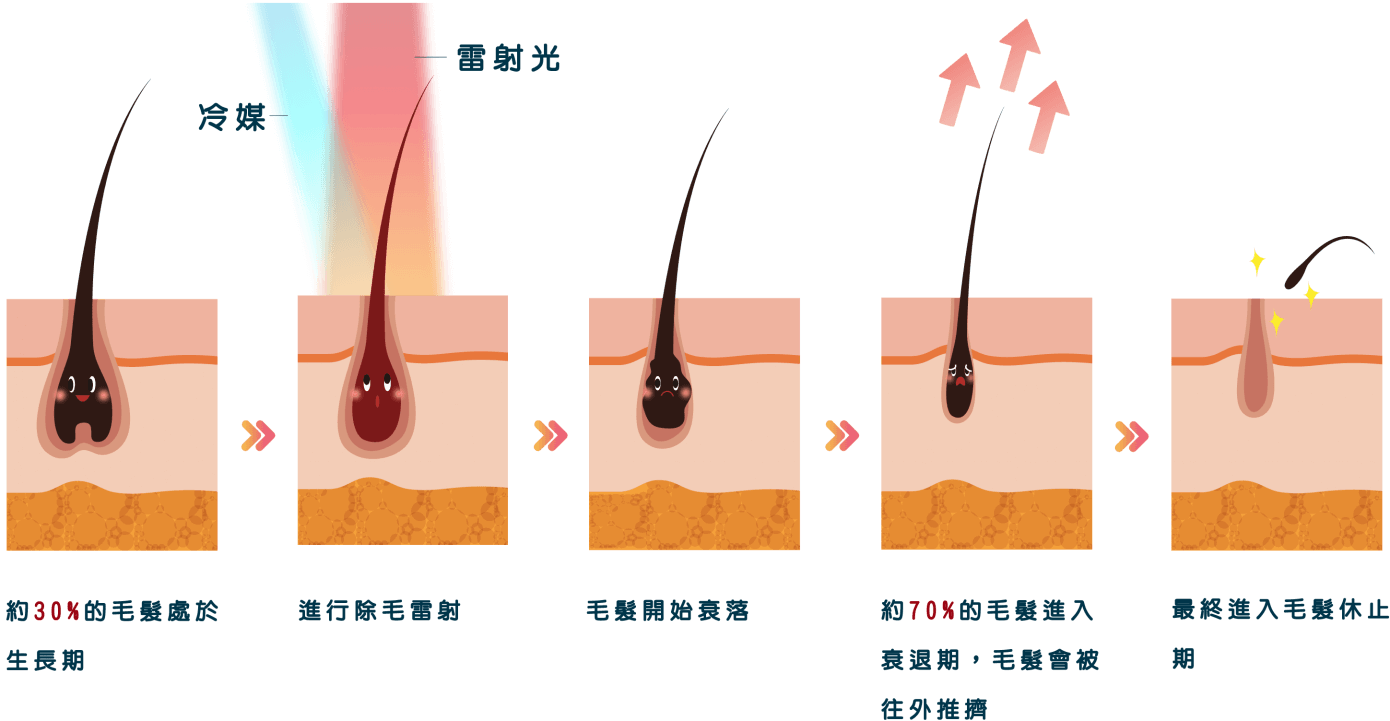 亞歷山大雷射除毛過程