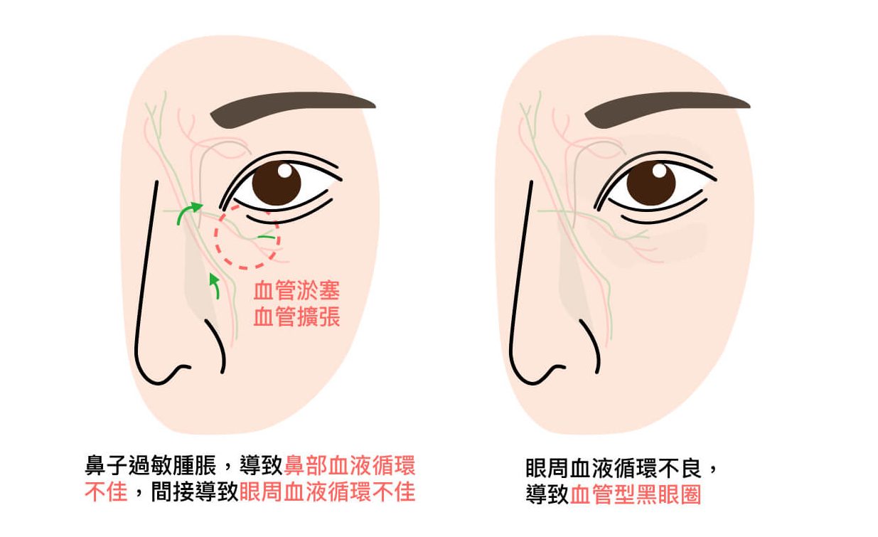 黑眼圈類型