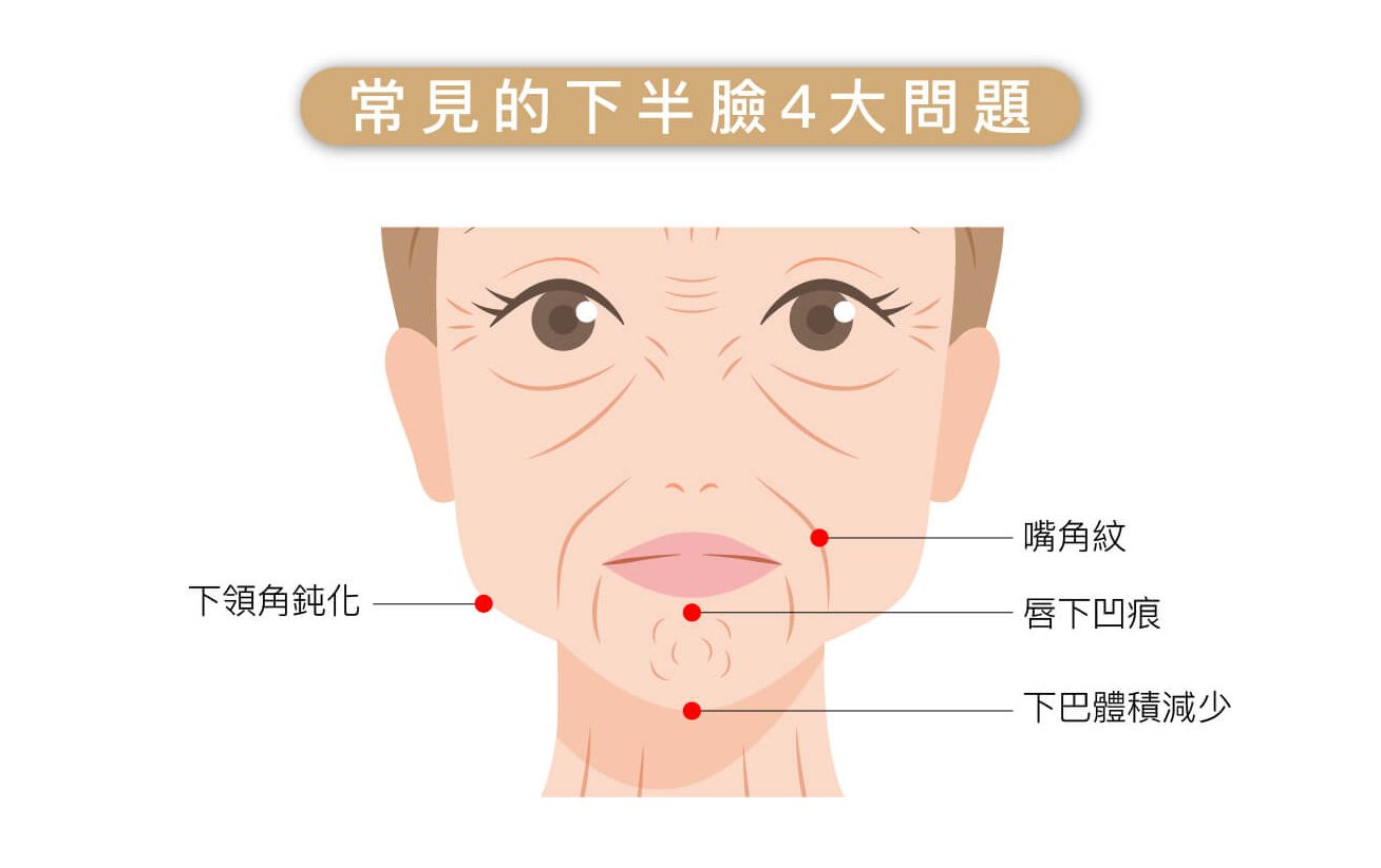 下巴打玻尿酸