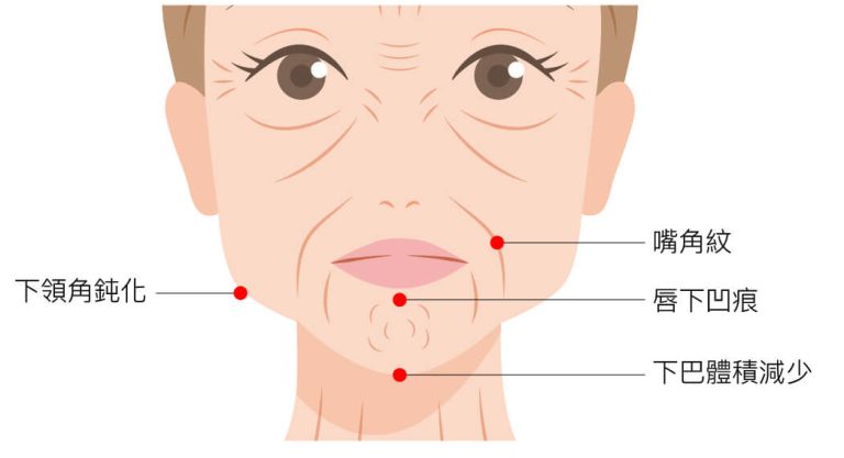 下巴打玻尿酸