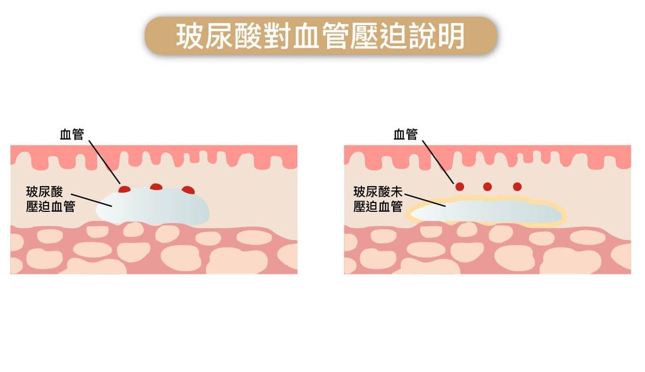 玻尿酸壓迫血管