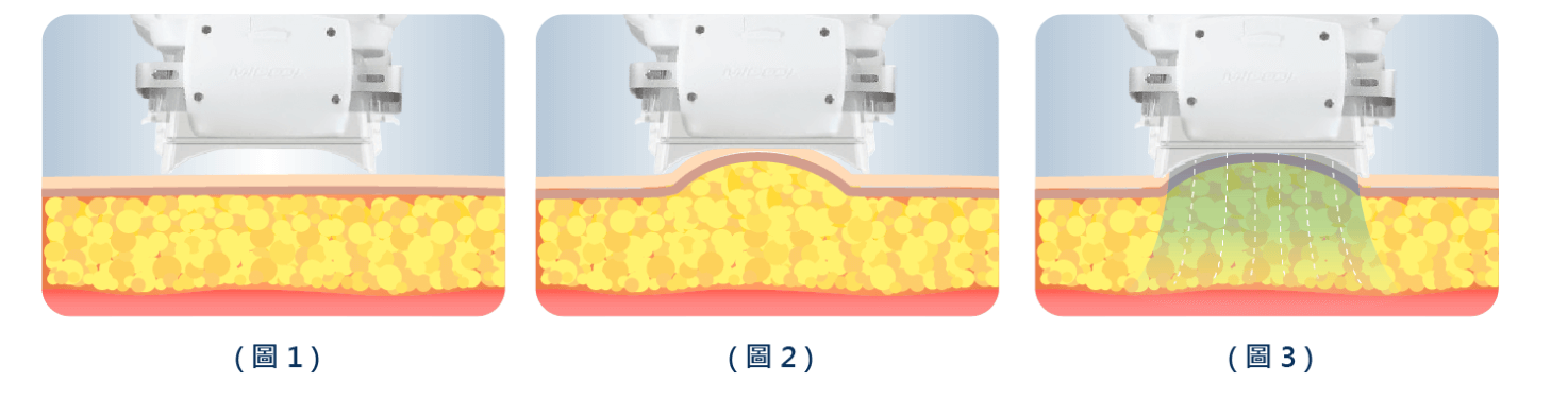 冷凍減脂瘦小腹原理